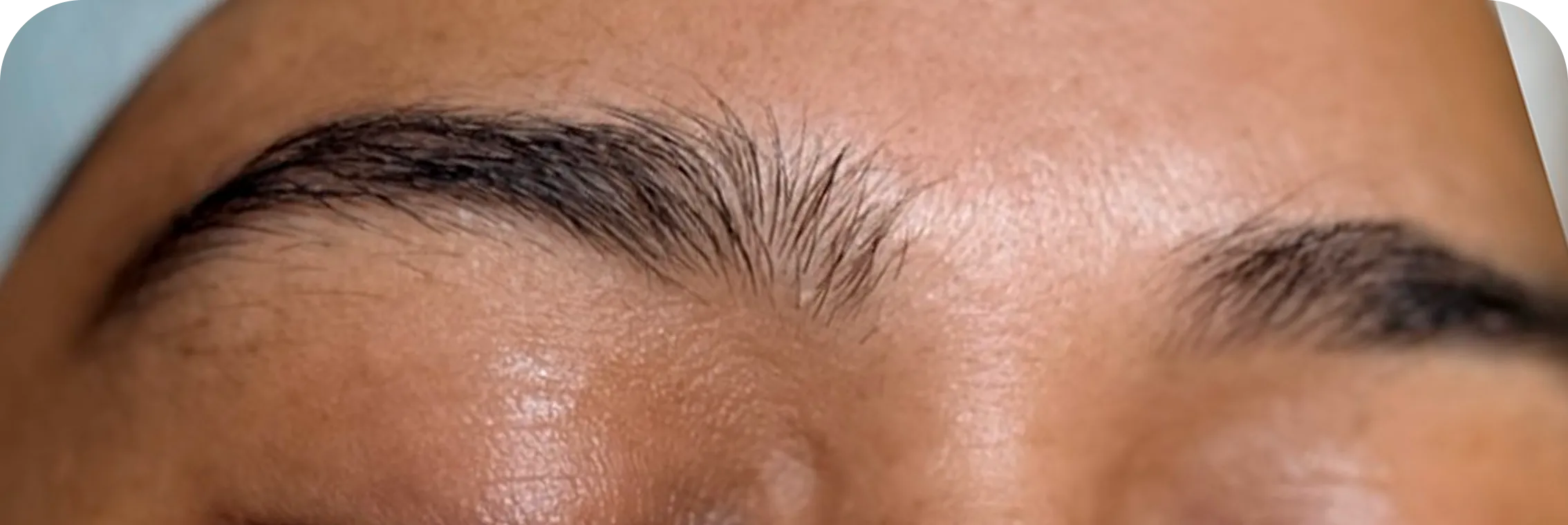 Brows, case 1: before the treatment.